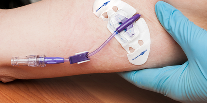 A close-up view of a person's forearm with a medical device secured by adhesive. The device includes a clear tube connected to a purple connector, indicating intravenous access. A gloved hand is also visible, suggesting a healthcare setting.