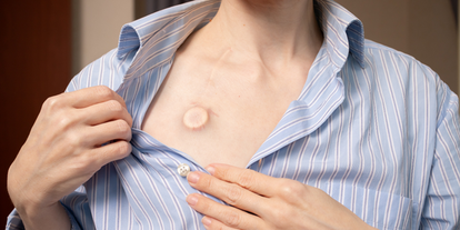 A person wearing a blue and white striped shirt is revealing a small, circular scar on their chest. The individual is gently pulling the shirt open to display the scar, which appears to be healed. The background is blurred, focusing on the person's upper body.