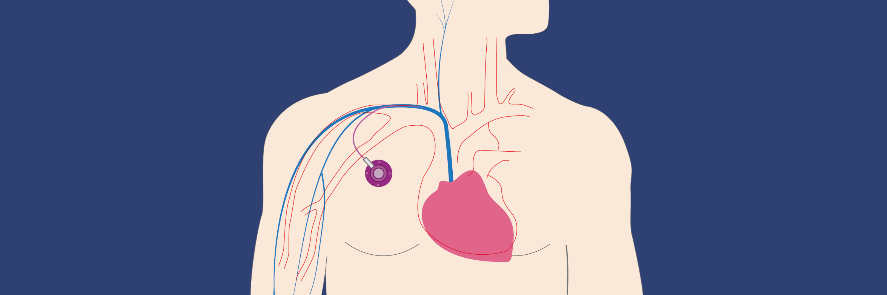 An illustration of a human torso focusing on the heart, depicted in pink, and major blood vessels represented in blue. The background is dark blue, emphasizing the anatomical features.