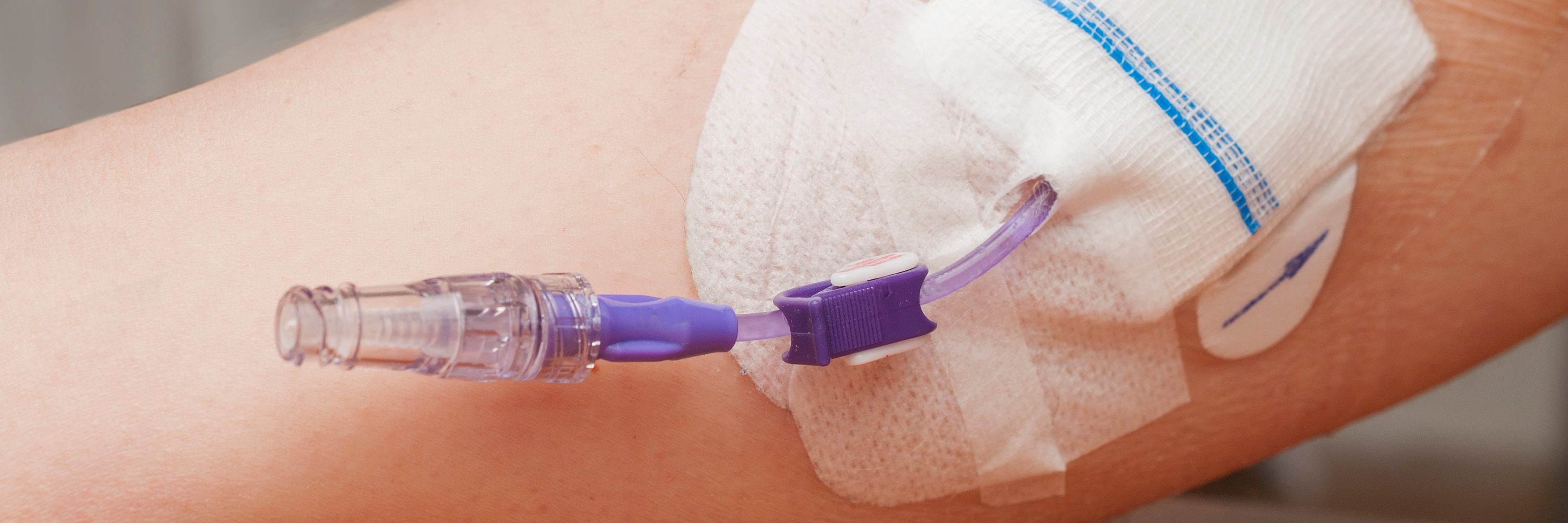 A close-up of a person's forearm shows a medical IV setup. A clear catheter is secured with a bandage, and a purple connector is attached, indicating an intravenous line for administering fluids or medications.