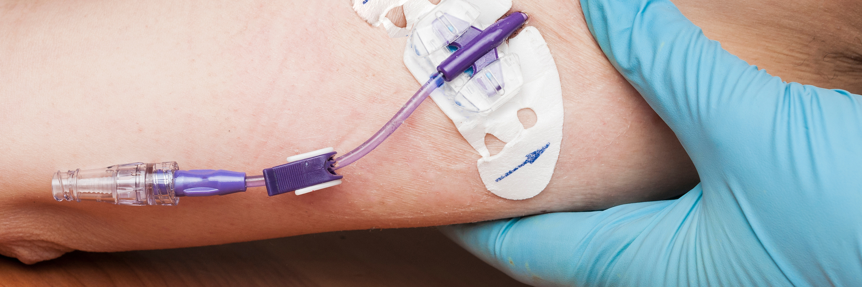 A close-up of a person's arm with a medical IV catheter secured in place. A gloved hand is positioned near the catheter, indicating healthcare assistance. The catheter is attached to a clear tube for administering fluids or medications.