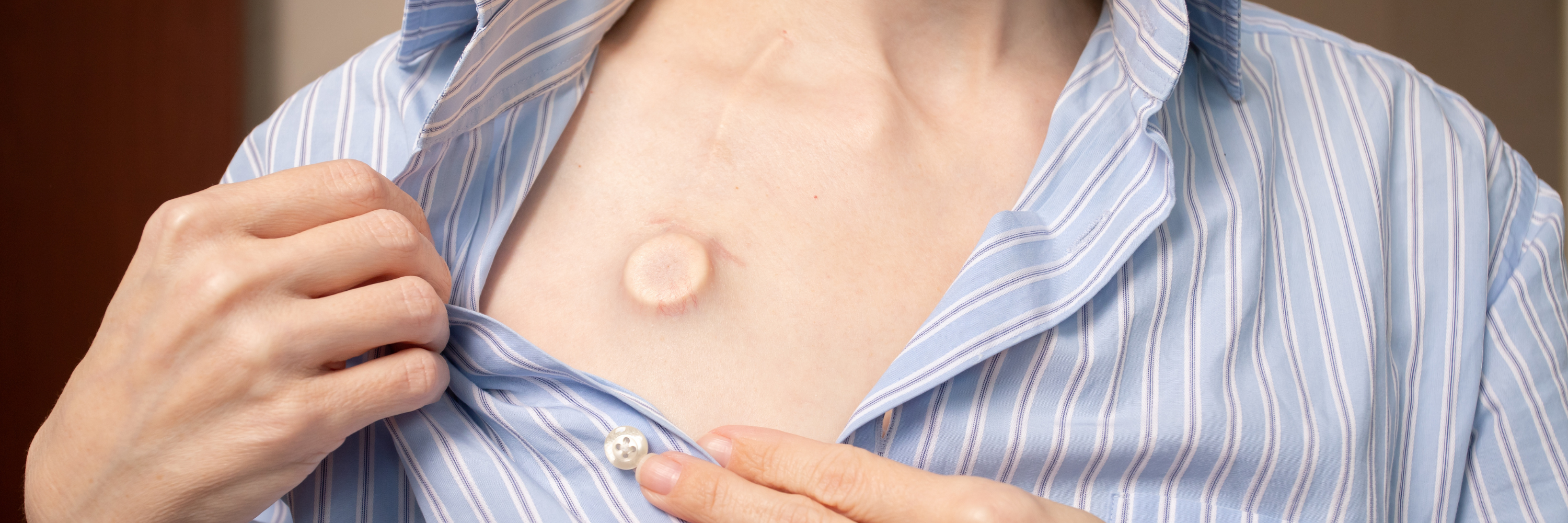 The image shows a person lifting the collar of a blue striped shirt to reveal a circular skin patch on their chest. The area around the patch appears healed, indicating prior medical treatment or the presence of a device.